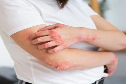 Dermatitis atopica