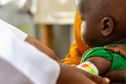 Desnutrición infantil y otras consecuencias de la grave crisis humanitaria actual - Imagen cedida por World Vision