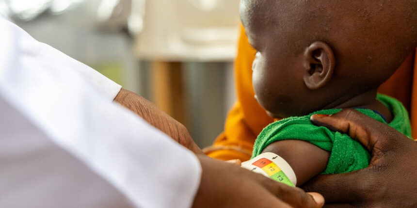 Desnutrición infantil y otras consecuencias de la grave crisis humanitaria actual - Imagen cedida por World Vision
