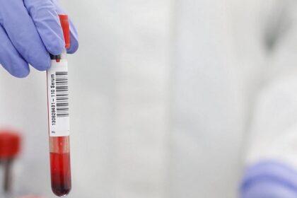Prueba de sangre de Grifols para detectar la malaria en sangre donada - Imagen de Stock