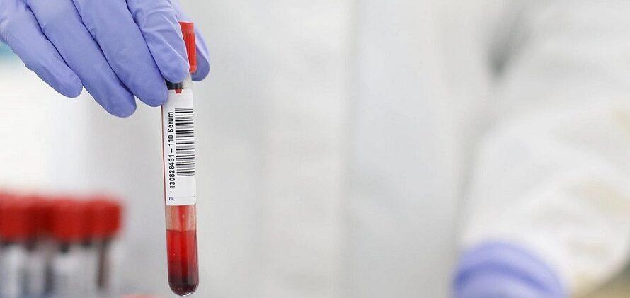 Prueba de sangre de Grifols para detectar la malaria en sangre donada - Imagen de Stock