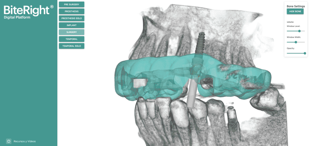 Visor 3D con hueso BiteRight Digital Platform