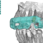 Visor 3D con hueso BiteRight Digital Platform